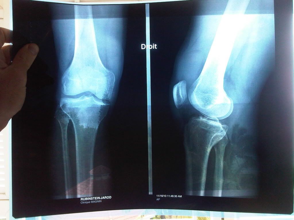 Non Displaced Fractured Patella